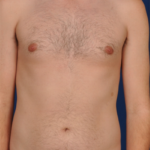 VASER Hi Def Liposuction Before & After Patient #6119
