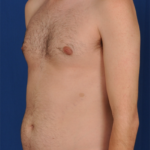 VASER Hi Def Liposuction Before & After Patient #6119
