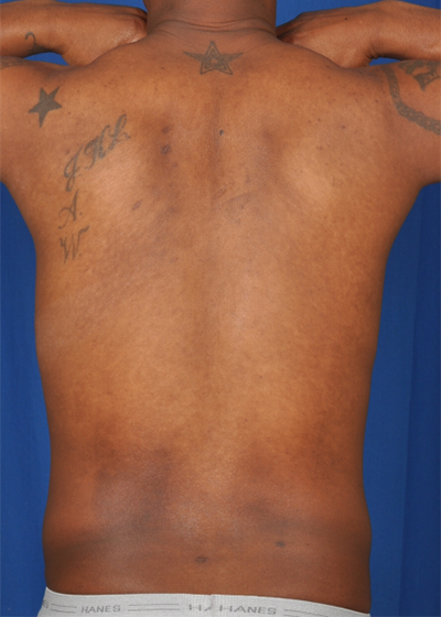 VASER Hi Def Liposuction Before & After Patient #6126