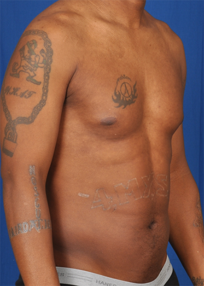 VASER Hi Def Liposuction Before & After Patient #6126