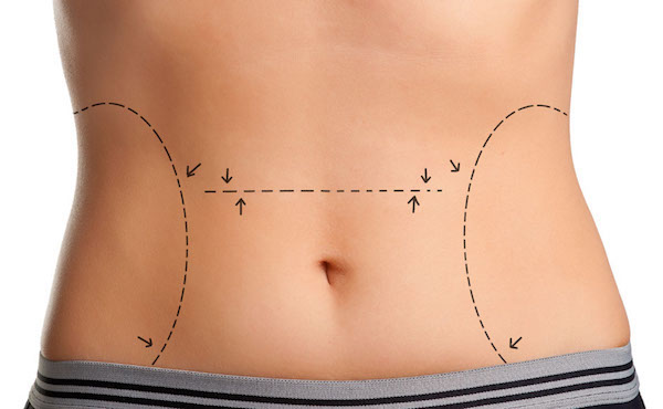 Liposuction vs. Tummy Tuck - Millard, John ()