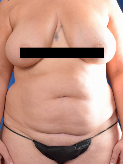 Tummy Tuck Before & After Patient #6593