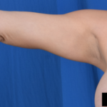 Arms Liposuction Before & After Patient #6513