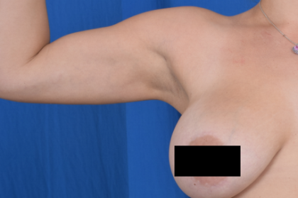 Arms Liposuction Before & After Patient #6513