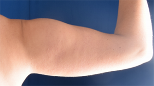 Arms Liposuction Before & After Patient #6432