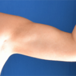 Arms Liposuction Before & After Patient #6432