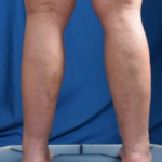 Legs Liposuction Before & After Patient #6544