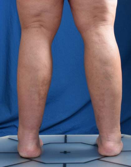 Legs Liposuction Before & After Patient #6544