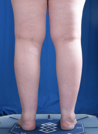 Legs Liposuction Before & After Patient #6551
