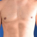 Gynecomastia Before & After Patient #6461