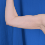 Arms Liposuction Before & After Patient #6411