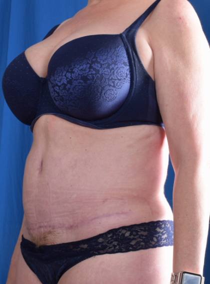 Tummy Tuck Before & After Patient #6484
