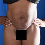 Tummy Tuck Before & After Patient #6477