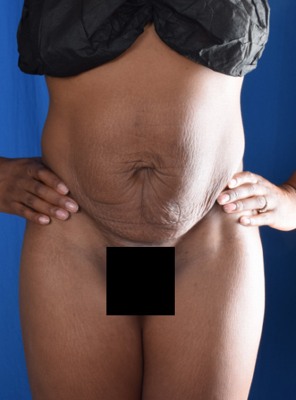 Tummy Tuck Before & After Patient #6477