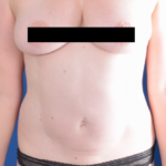 Standard Liposuction Before & After Patient #6495