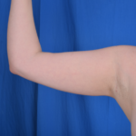 Arms Liposuction Before & After Patient #6411