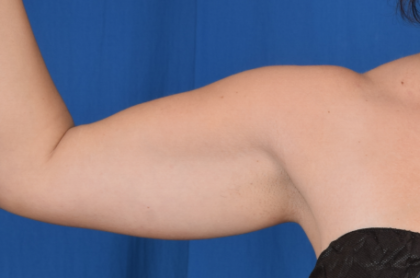 Arms Liposuction Before & After Patient #6432