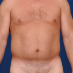 VASER Hi Def Liposuction Before & After Patient #6452
