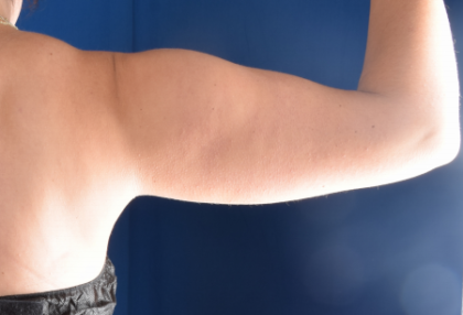 Arms Liposuction Before & After Patient #6432