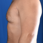 Gynecomastia Before & After Patient #6461