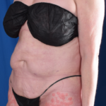 Tummy Tuck Before & After Patient #6484