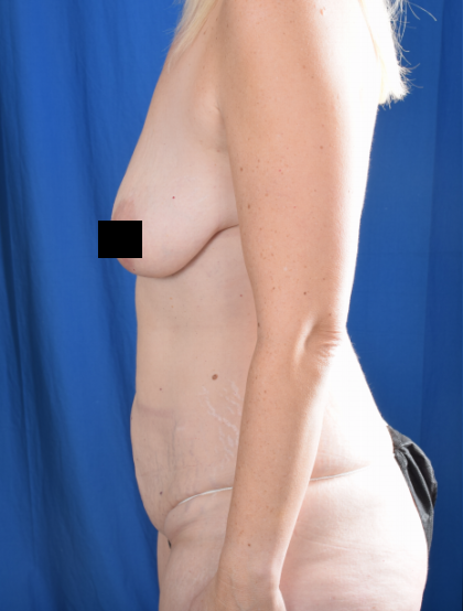 Tummy Tuck Before & After Patient #6468