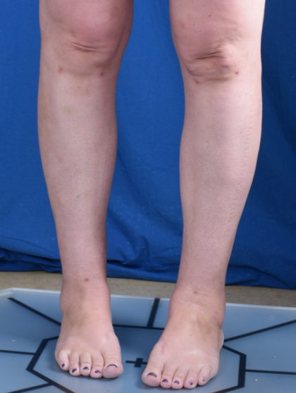 Legs Liposuction Before & After Patient #6551