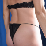 Standard Liposuction Before & After Patient #6563