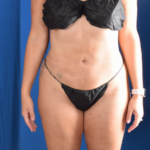 VASER Hi Def Liposuction Before & After Patient #6543