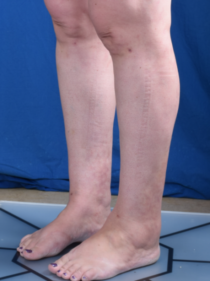 Legs Liposuction Before & After Patient #6551