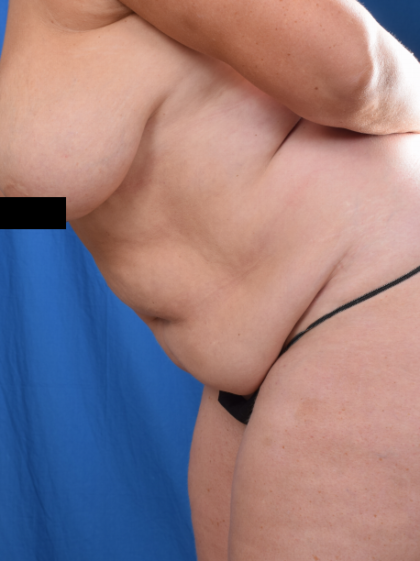 Tummy Tuck Before & After Patient #6593