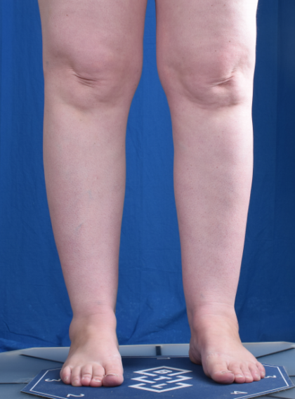 Legs Liposuction Before & After Patient #6551