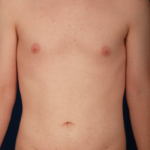 VASER Hi Def Liposuction Before & After Patient #6315