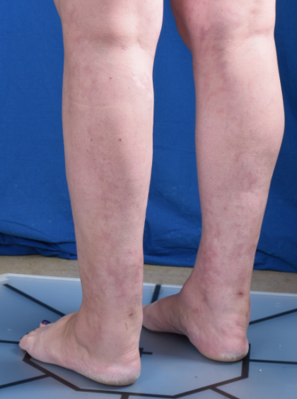 Legs Liposuction Before & After Patient #6551