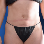 Standard Liposuction Before & After Patient #6563