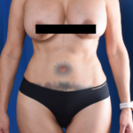 VASER Hi Def Liposuction Before & After Patient #6600