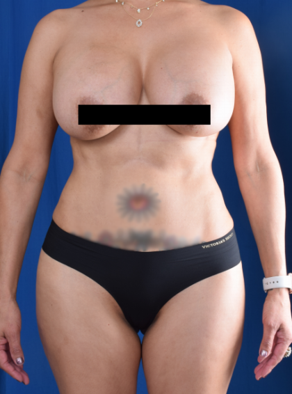 VASER Hi Def Liposuction Before & After Patient #6600