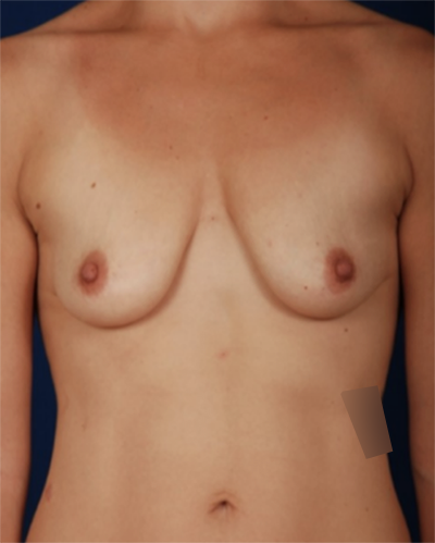 Breast Augmentation Before & After Patient #6750