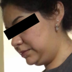 Chin Liposuction Before & After Patient #6755
