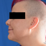 Chin Liposuction Before & After Patient #6758
