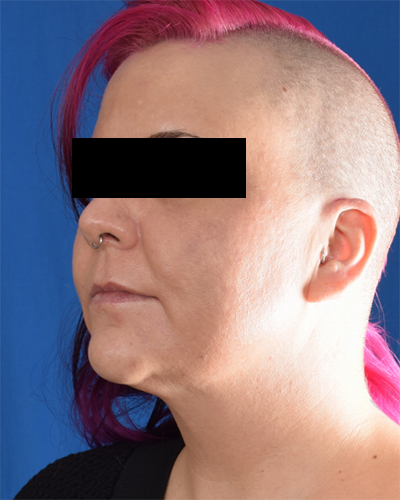 Chin Liposuction Before & After Patient #6758