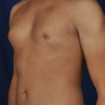 Gynecomastia Before & After Patient #6765