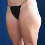 Legs Liposuction Before & After Patient #6768