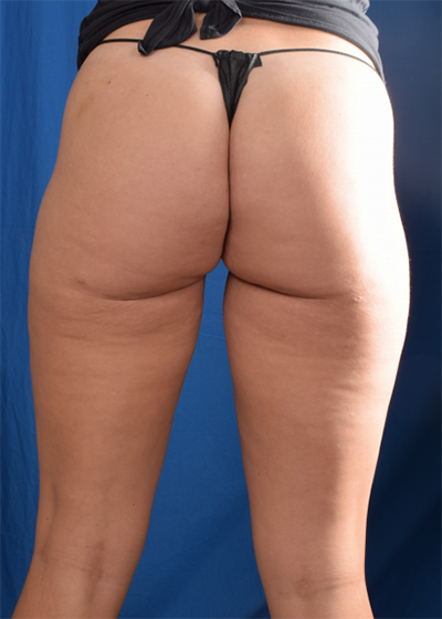 Legs Liposuction Before & After Patient #6768