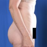 Standard Liposuction Before & After Patient #6775