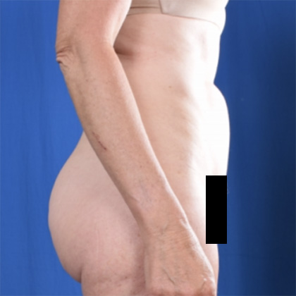 Standard Liposuction Before & After Patient #6775
