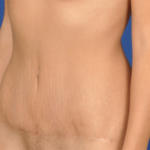 Tummy Tuck Before & After Patient #6781
