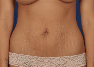 Tummy Tuck Before & After Patient #6781
