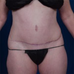 Tummy Tuck Before & After Patient #6786