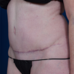 Tummy Tuck Before & After Patient #6786